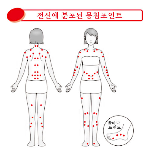 전신에 분포된 뭉침포인트