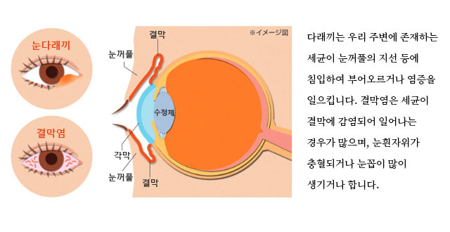 다래끼는 우리 주변에 존재하는 세균이 눈꺼풀의 지선 등에 침입하여 부어오르거나 염증을 일으킵니다.